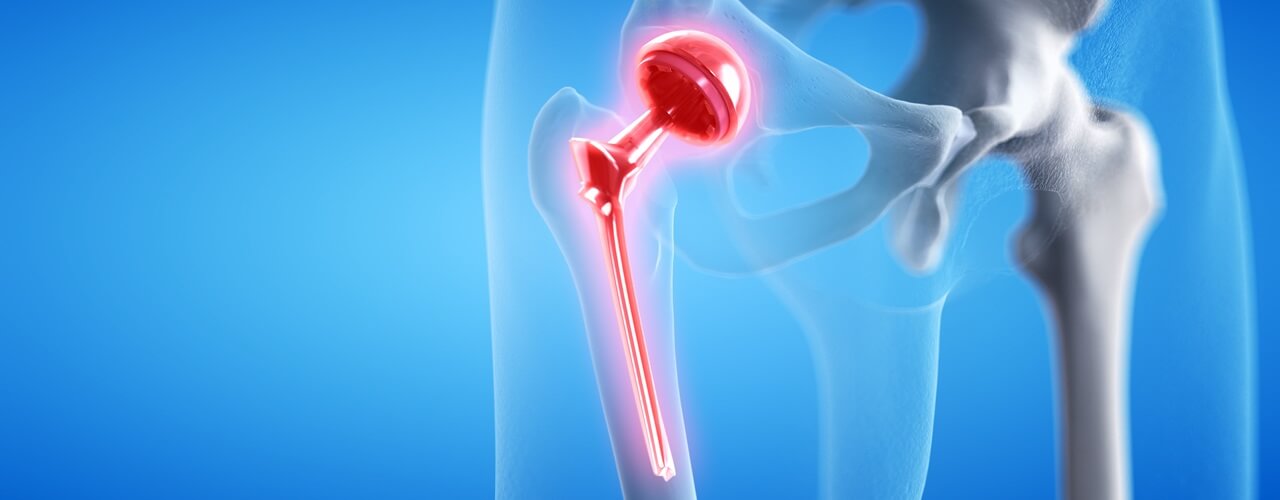 Hip pain relief treatment in Kansas