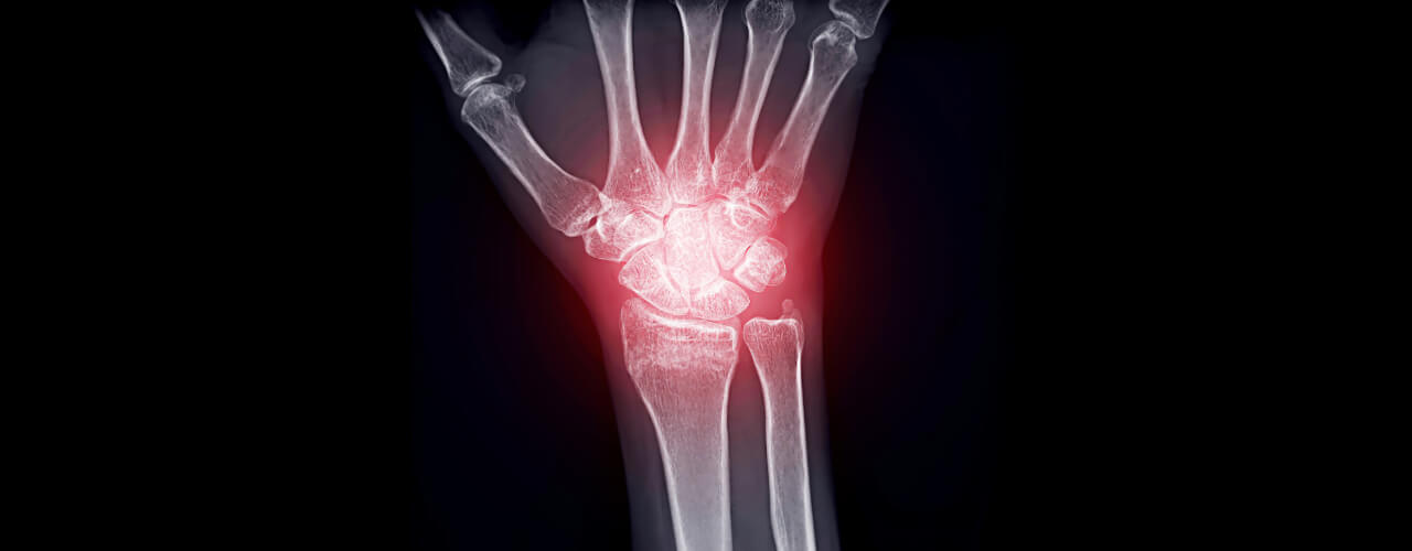 How to Manage Joint Inflammation from Arthritis